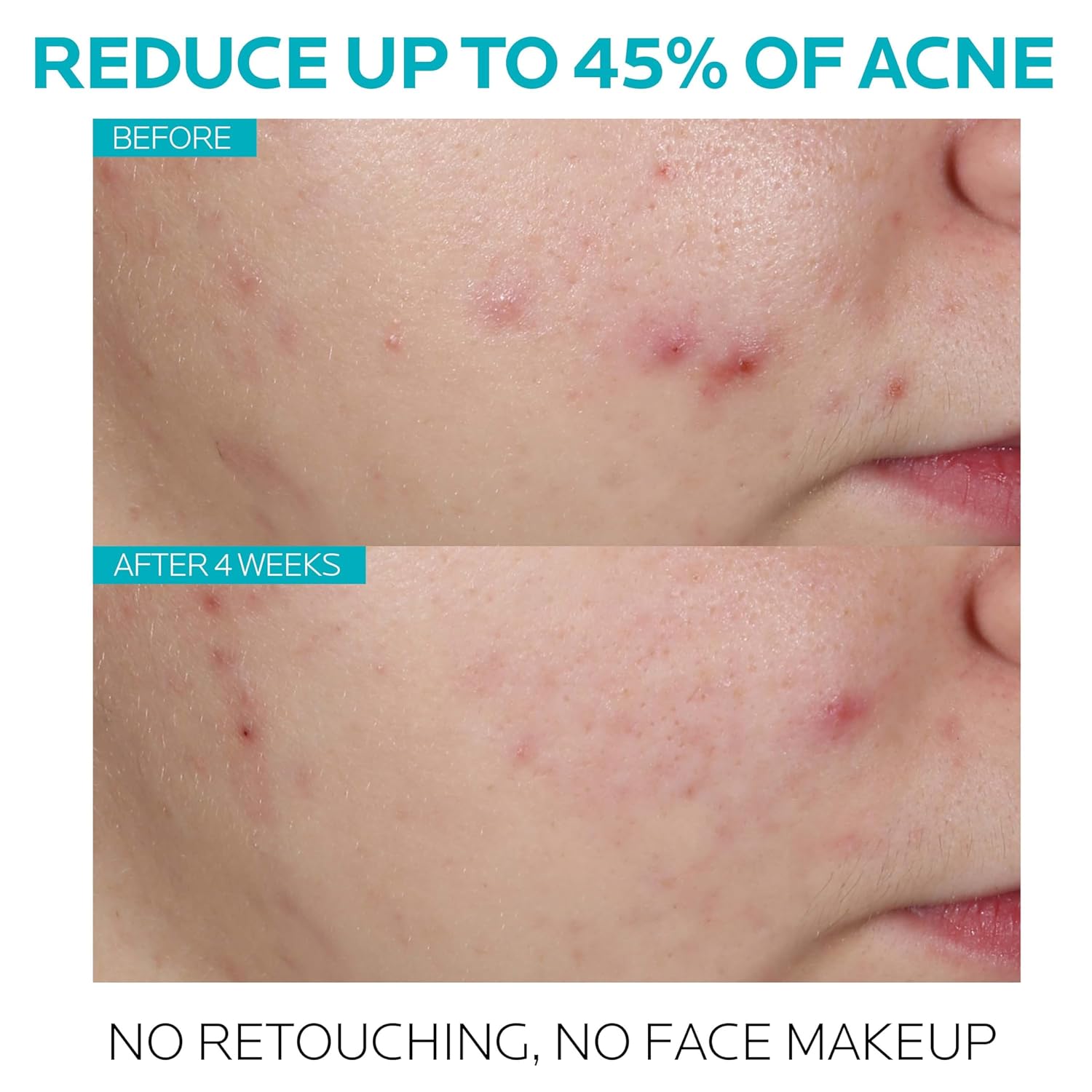 La Roche-Posay Effaclar 1.5% Salicylic Acid Serum, Acne Treatment For Face With Glycolic Acid & Niacinamide, Acne Serum Helps Clear Blackheads, Whiteheads, Pimples & Reduces Post Acne Marks - Image 2