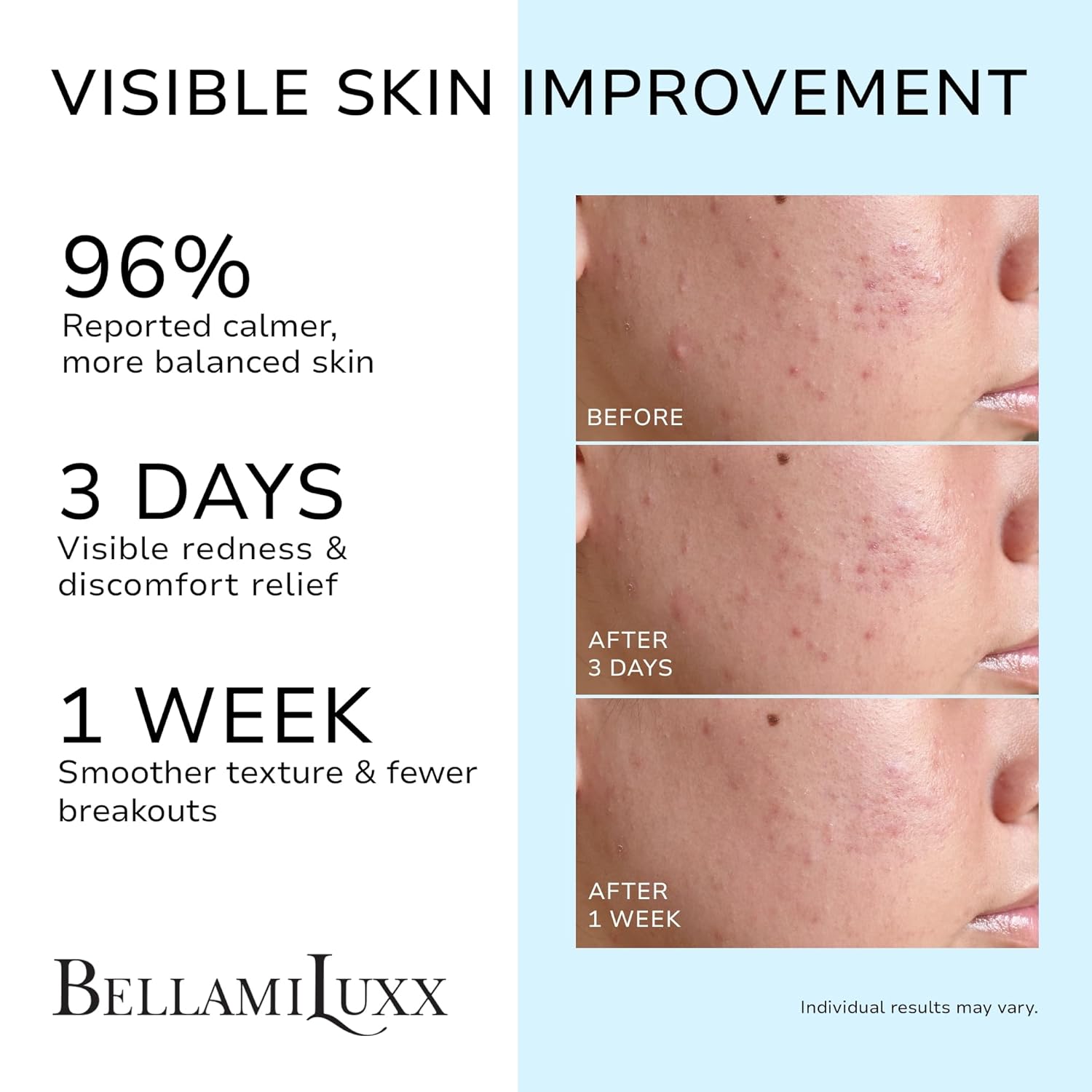 BellamiLuxx Cystic Acne Treatment for Face: Hormonal Acne Treatment Cream for Teens & Adults - Salicylic Acid & Tea Tree Oil Pimple Spot Remover - Anti-Acne Moisturizer Reduces Redness, Blemishes - Image 3