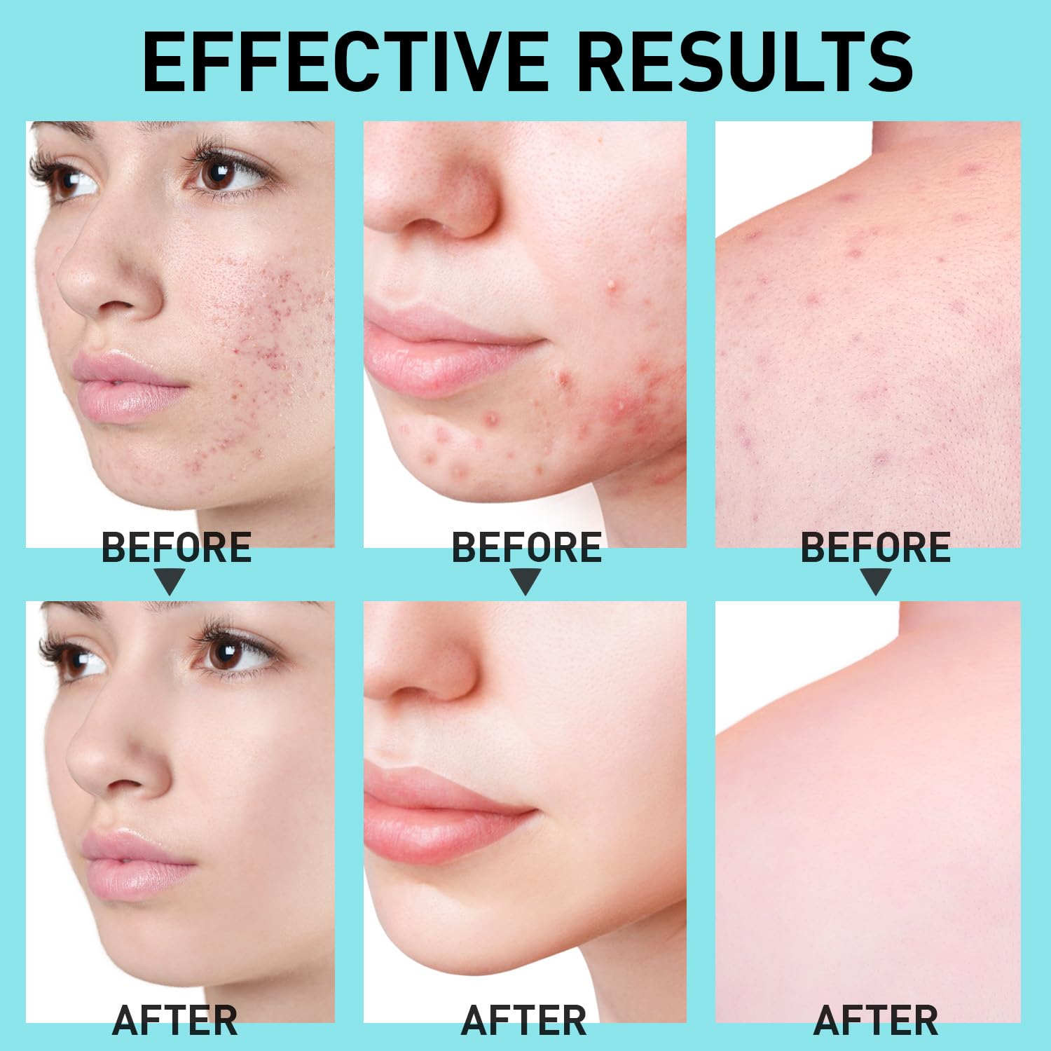 Salicylic Acid Acne Spot Treatment: Cystic Hormonal Pimple Cream for Stubborn Zits, Blemish Breakout & Post-Acne Scars - Face, Body & Back, Teens-Adults, 1.8 oz - Image 3