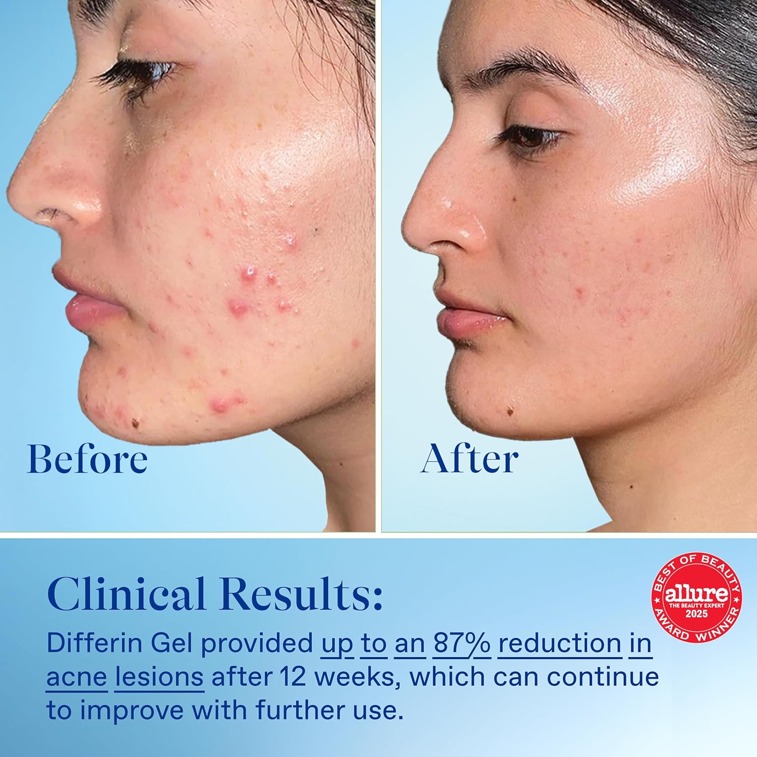 Differin Acne Treatment Gel, 30 Day Supply, Retinoid Treatment for Face with 0.1% Adapalene, Gentle Skin Care for Acne Prone Sensitive Skin, 15g Pump (Packaging May Vary) - Image 6