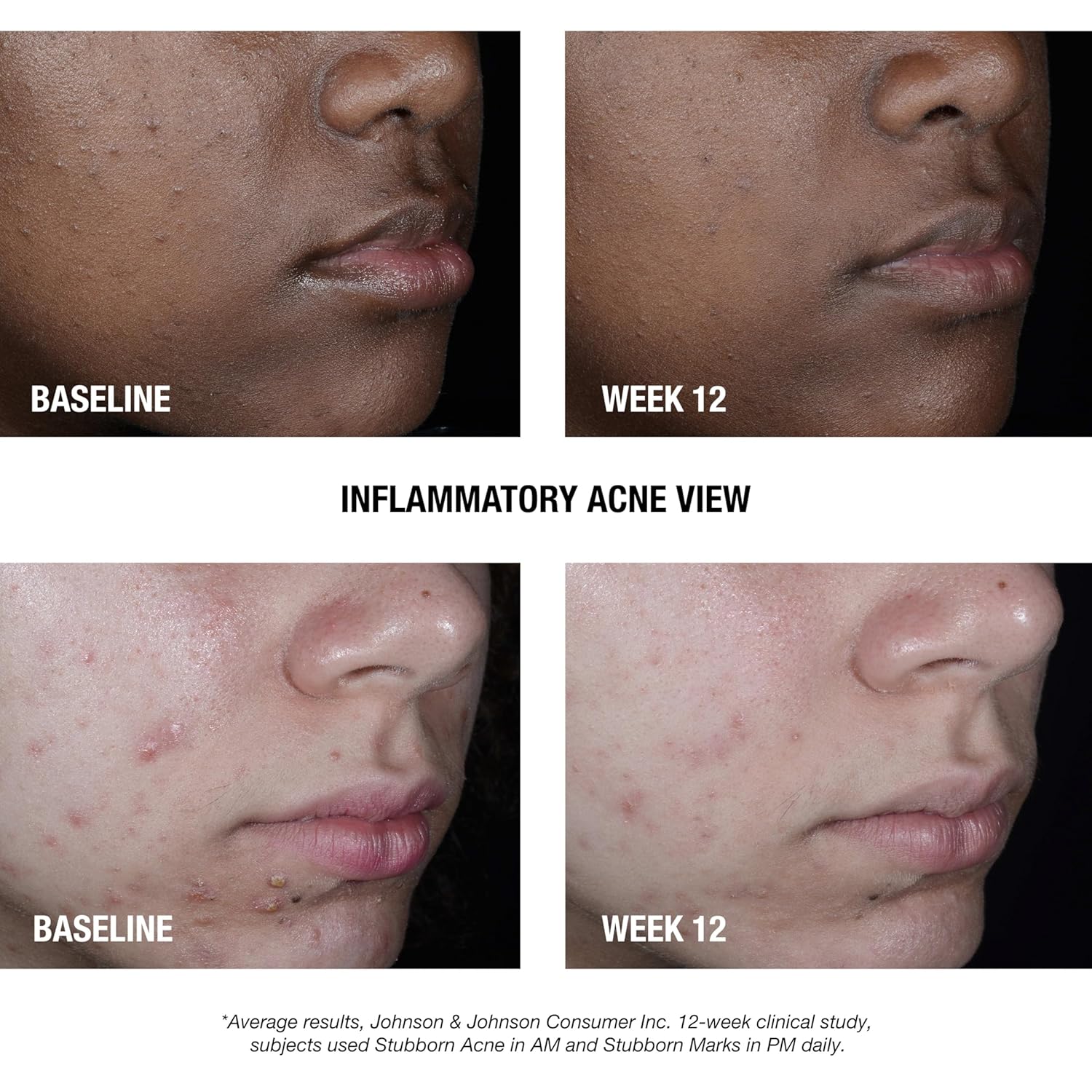 Neutrogena Stubborn Acne AM Face Treatment with 2.5% Micronized Benzoyl Peroxide Acne Medication, Oil-Free Daily Facial Treatment Reduces Size & Redness of Breakouts, Paraben-Free, 2.0 oz | 2.5%, Acne Medication, Oil-Free, Paraben-Free - Image 3