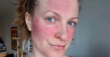 Ich habe Rosacea & mir hilft nur diese Skincare-Routine